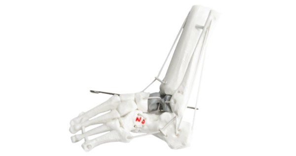 Vertical Talus Child Left